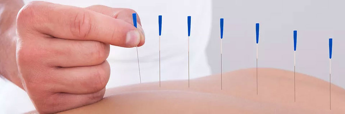 Medical Acupuncture image